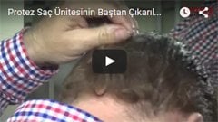 Protez Saç Ünitesinin Baştan Çıkarılması